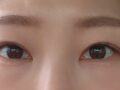 김홍진원장님 눈재수술, 눈매교정,트임