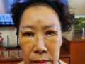 수술후기