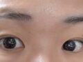 일미리 도언록 원장님 절개+윗트임 후기