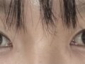 김홍진원장님 매몰 수술후기