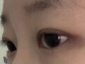 일미리 김홍진 원장님 자연유착+눈매교정+윗트임 후기