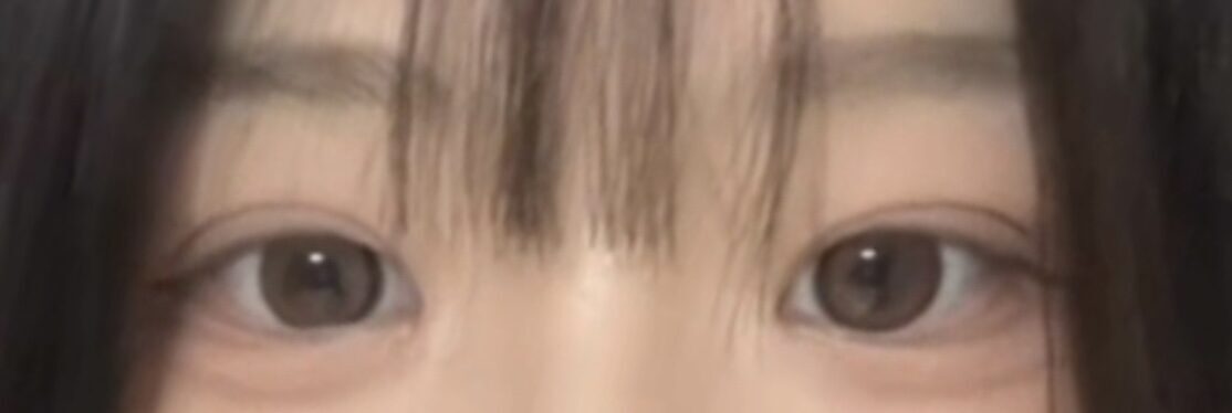 김홍진 원장님 자연유착 후기
