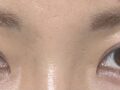 일미리 도언록 원장님 눈위 지방이식 + 비절개 쌍커풀 3개월차