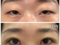 일미리 김홍진원장님, +3개월 완전절개 눈매교정 만족합니다