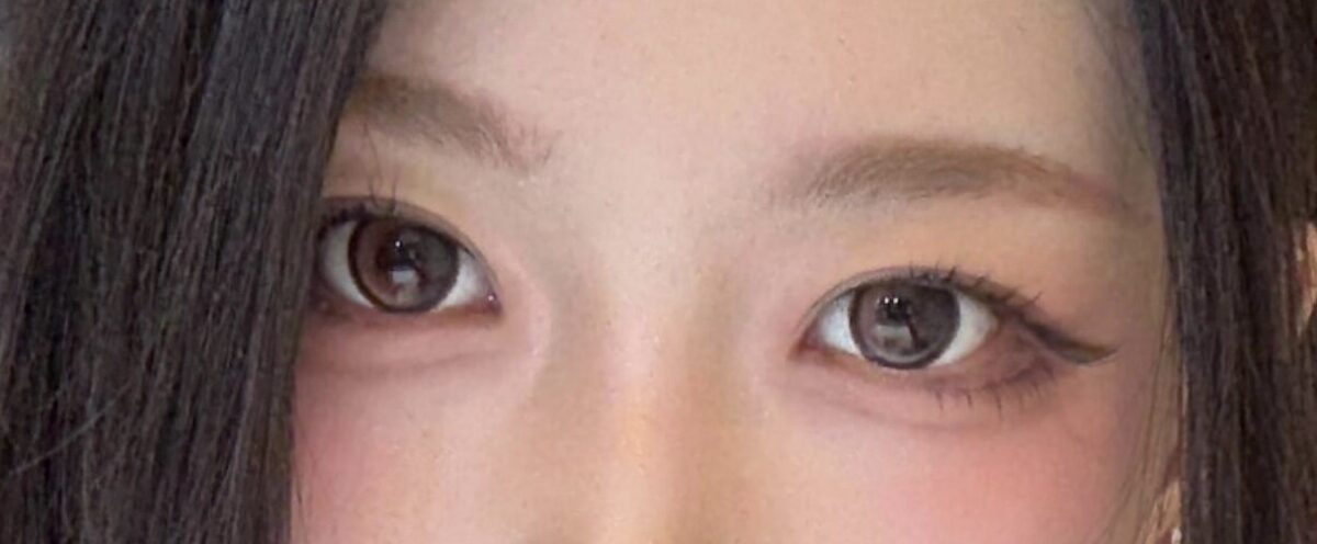 1mm성형외과 도언록 원장님 비절개 재수술