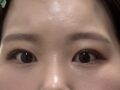 일미리 김홍진 원장님 자연유착 후기