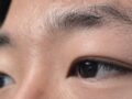 도언록원장님 눈매교정+쌍꺼풀